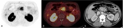 αvβ6-integrin targeted PET/CT imaging in pancreatic cancer patients using 68Ga-Trivehexin